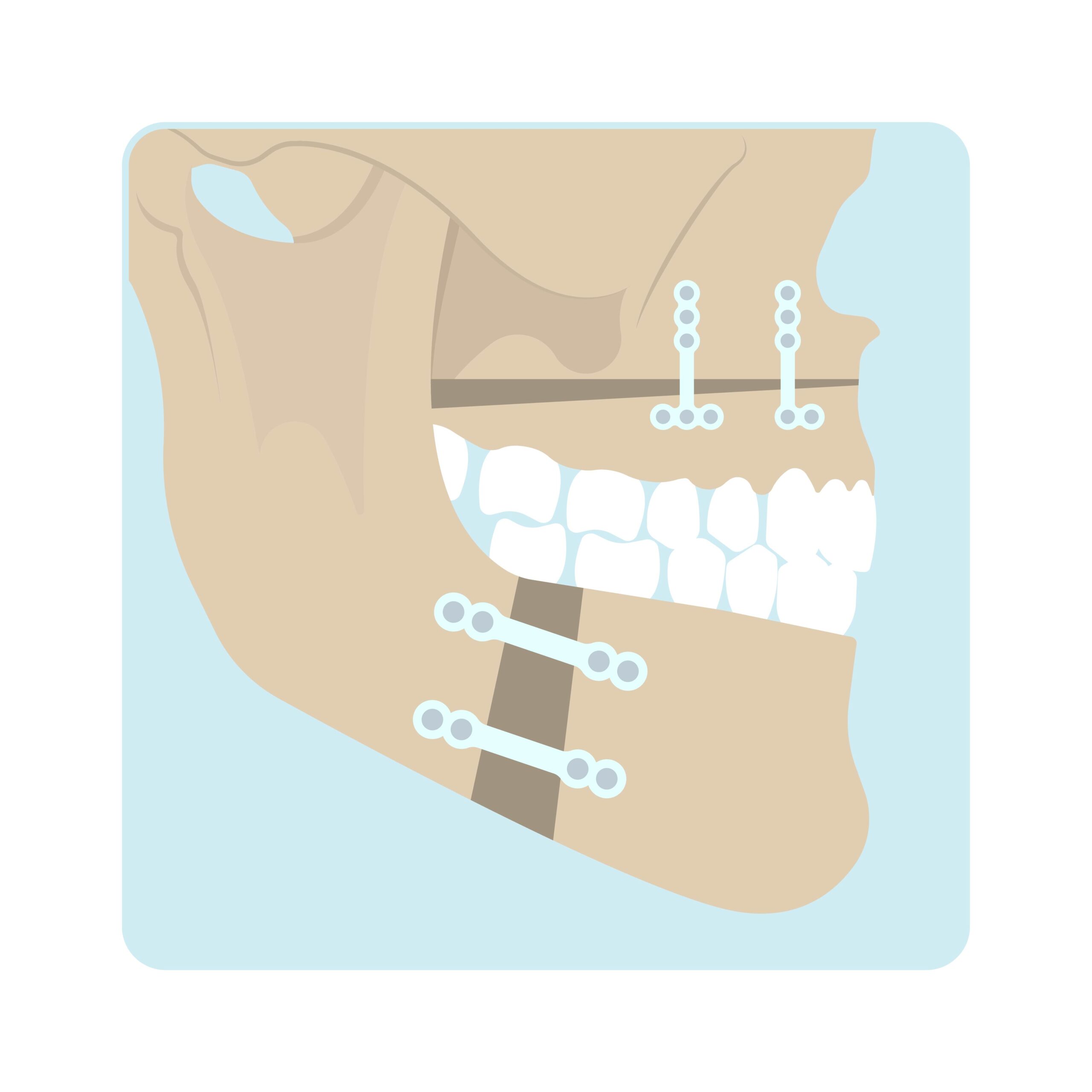 Kombiniert Kieferorthopädisch- Kieferchirurgische Therapie